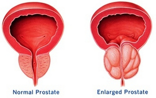 stymulacja montażu prostaty