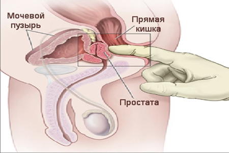masaż prostaty nie ma erekcji twaróg na penisie